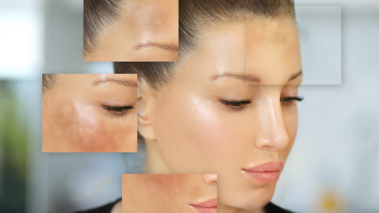 Pigmentation- A Comprehensive Guide