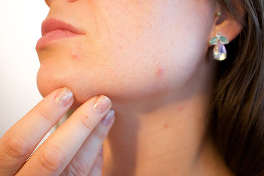 Woman with Sensitive Skin