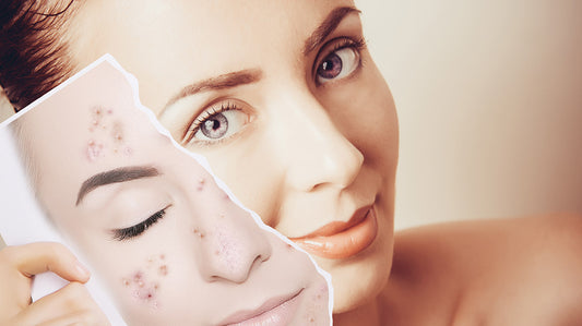 Here's How To Get Rid of Pigmentation Once & For All